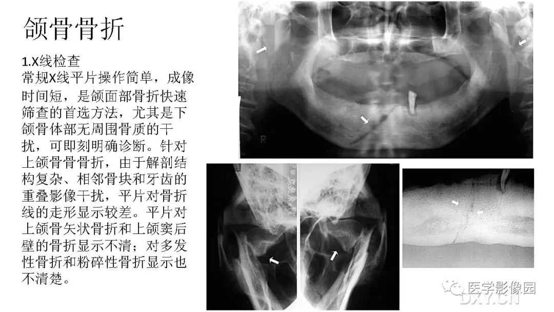 【PPT】常见口腔病例影像表现
