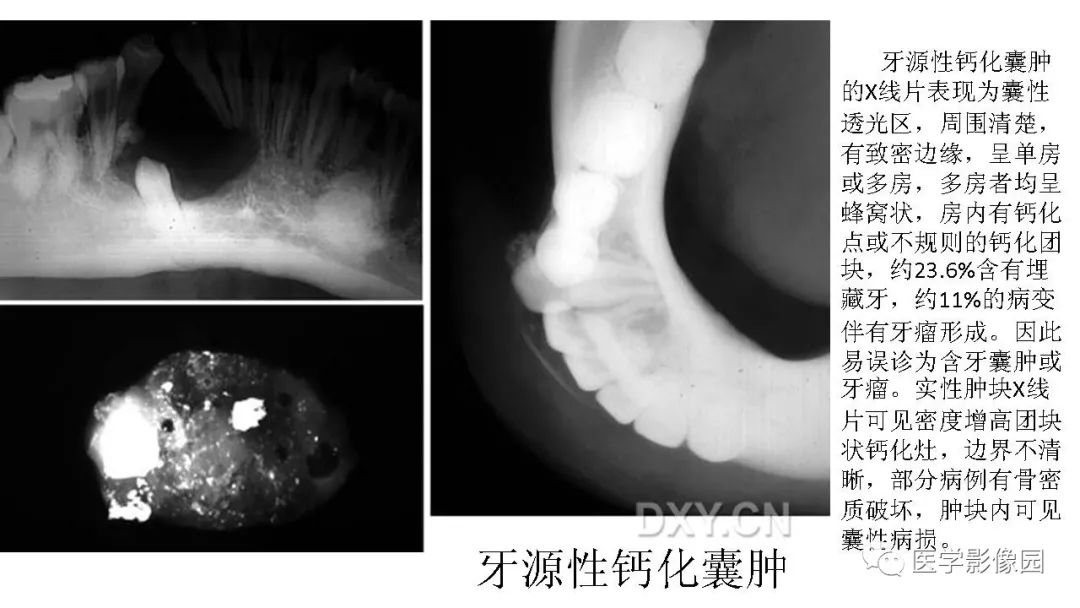 【PPT】常见口腔病例影像表现