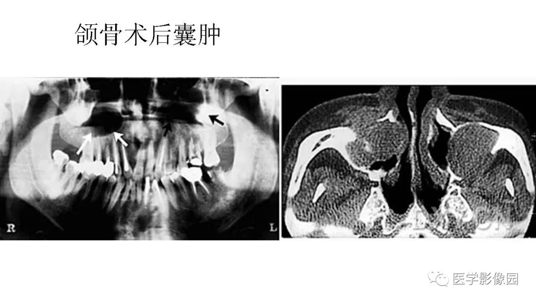 【PPT】常见口腔病例影像表现