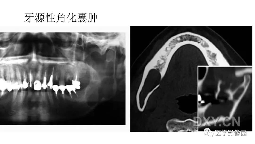 【PPT】常见口腔病例影像表现