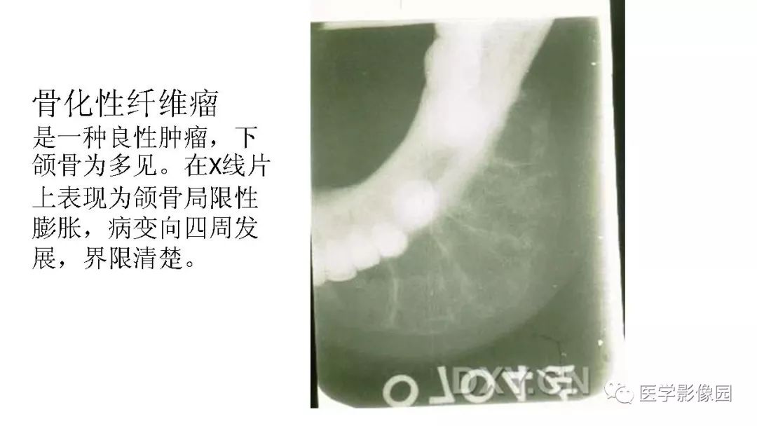【PPT】常见口腔病例影像表现