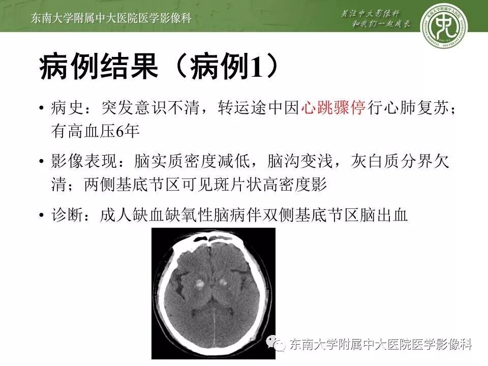【病例】双侧基底节区脑出血 VS 造影剂渗出 各1例CT