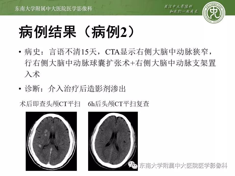 【病例】双侧基底节区脑出血 VS 造影剂渗出 各1例CT