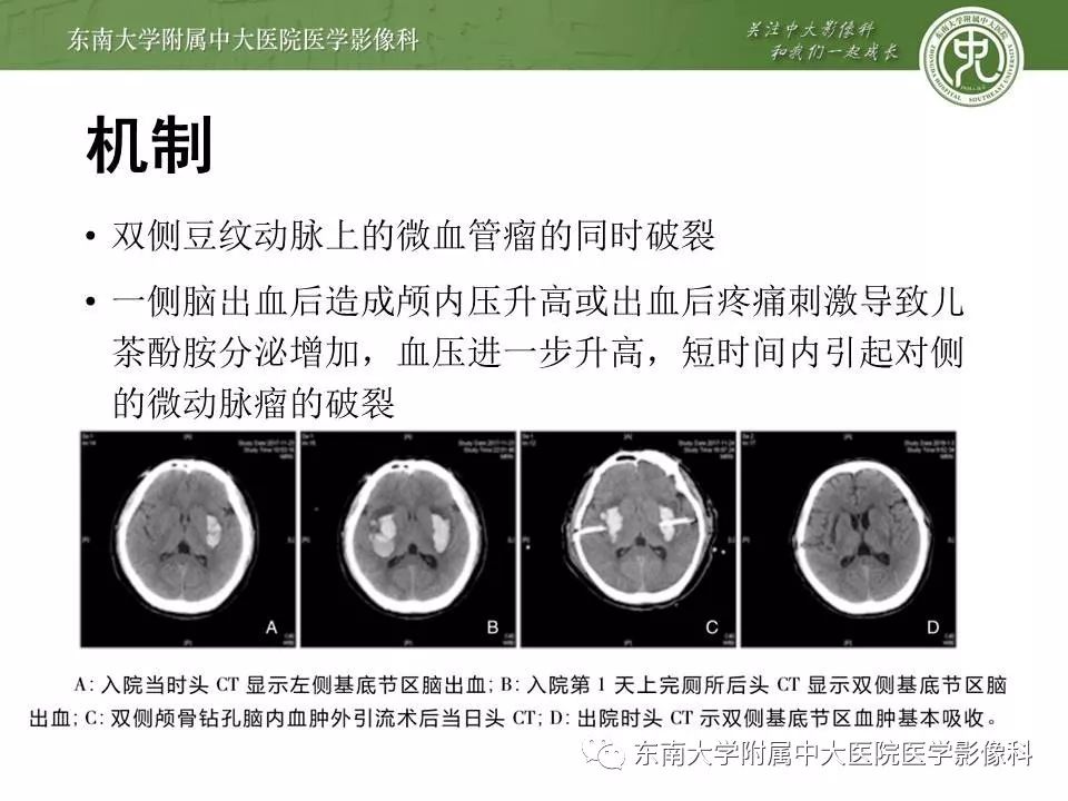 【病例】双侧基底节区脑出血 VS 造影剂渗出 各1例CT