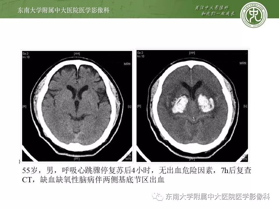 【病例】双侧基底节区脑出血 VS 造影剂渗出 各1例CT