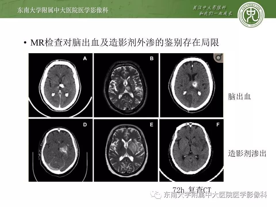 【病例】双侧基底节区脑出血 VS 造影剂渗出 各1例CT