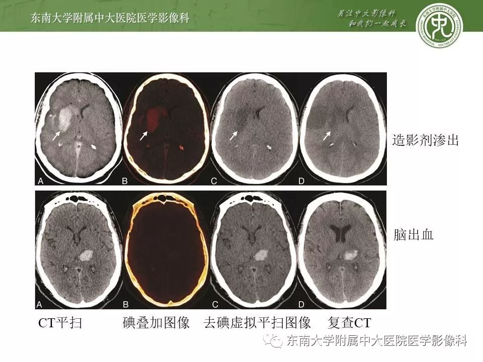 【病例】双侧基底节区脑出血 VS 造影剂渗出 各1例CT