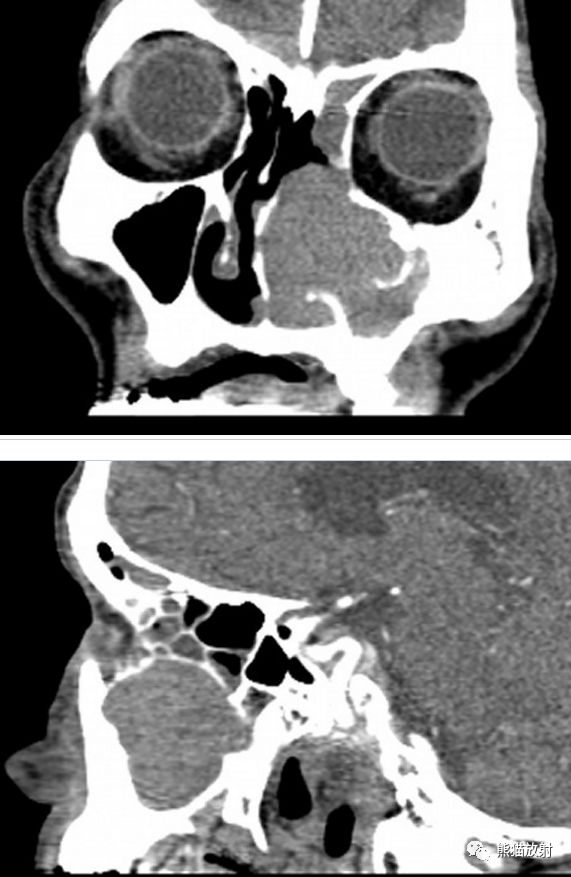 【病例】上颌窦内翻性乳头状瘤1例CT
