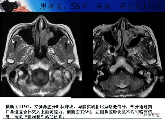 【病例】上颌窦内翻性乳头状瘤1例CT
