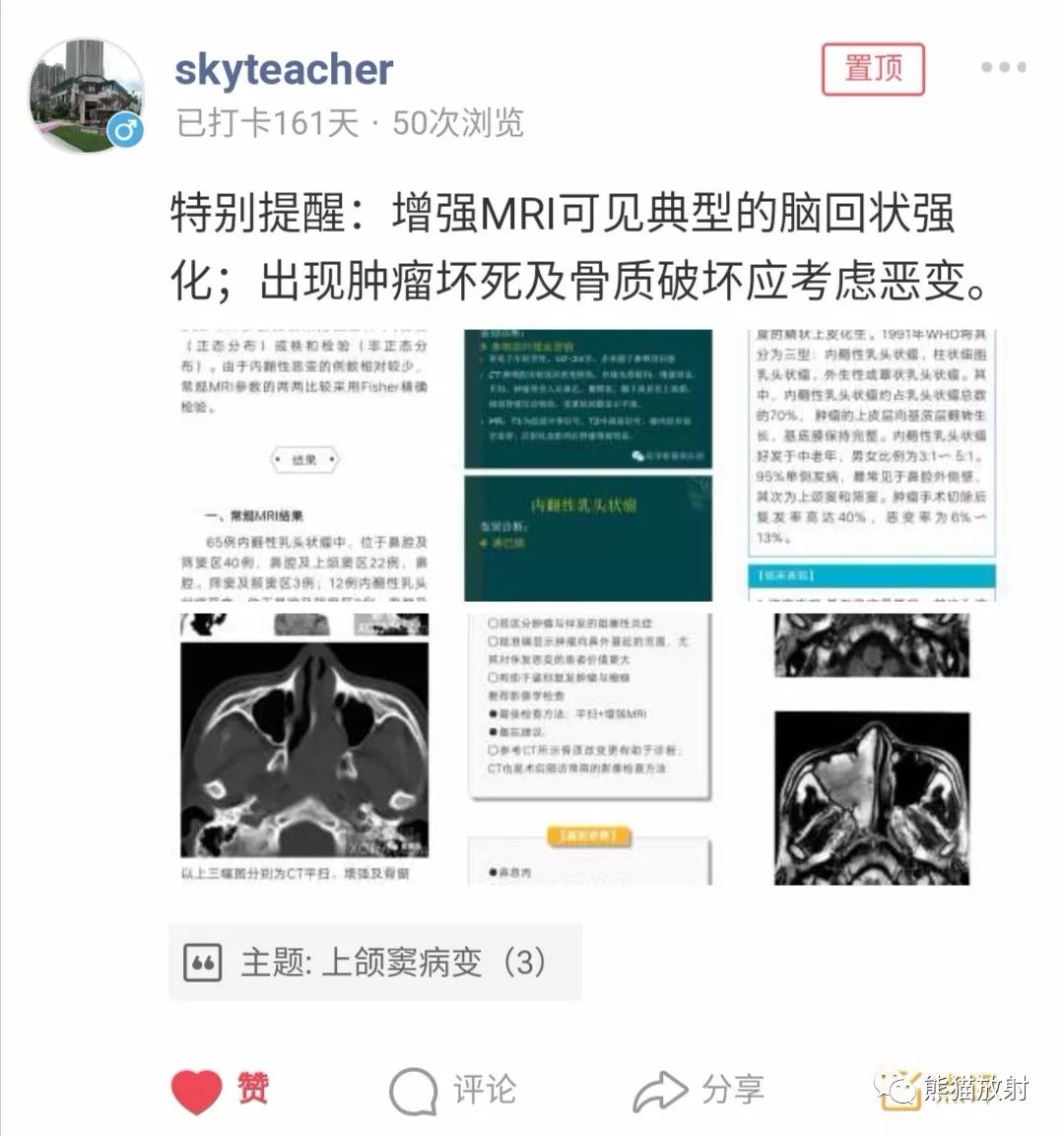 【病例】上颌窦内翻性乳头状瘤1例CT