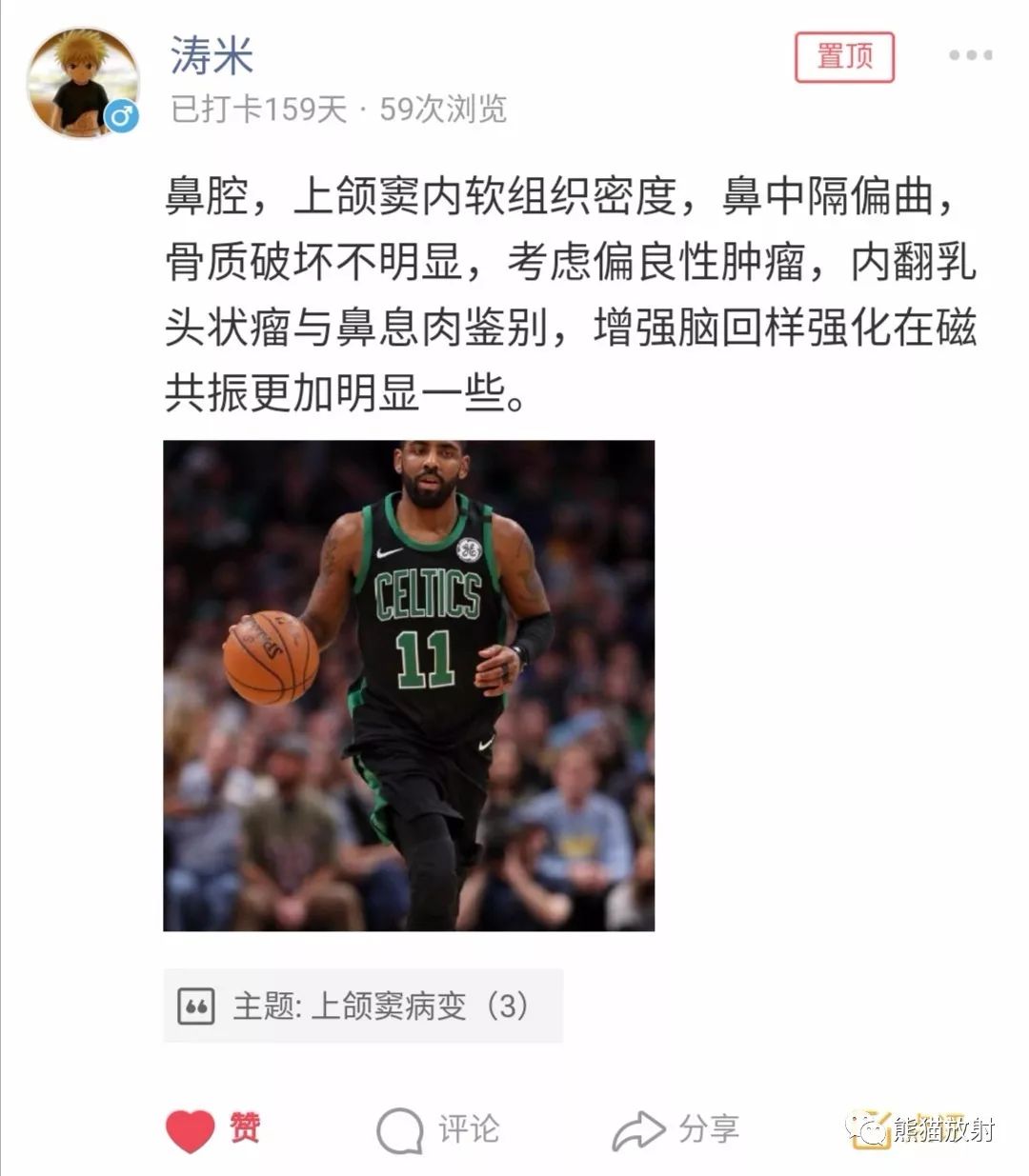【病例】上颌窦内翻性乳头状瘤1例CT
