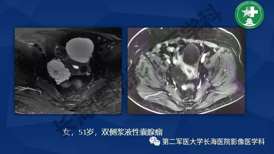【PPT】卵巢上皮性肿瘤影像诊断