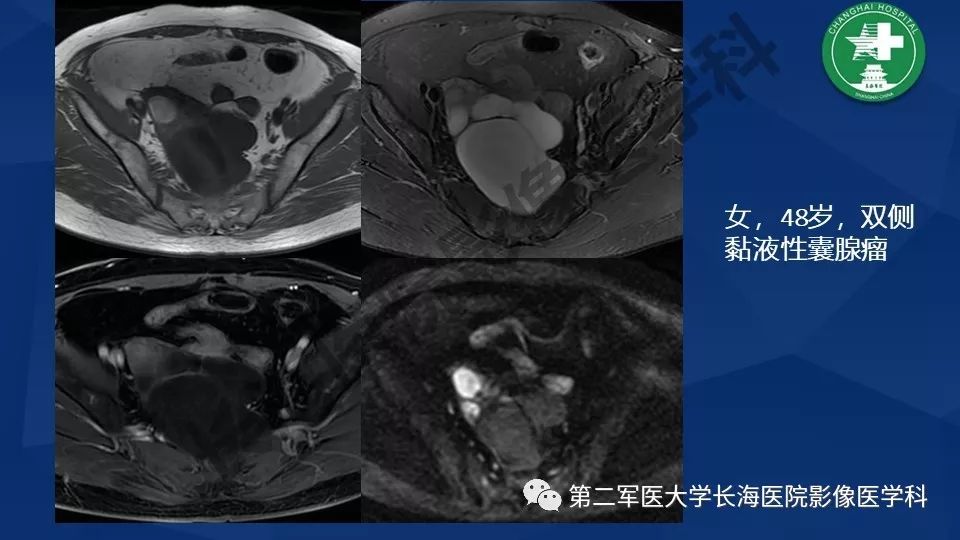 【PPT】卵巢上皮性肿瘤影像诊断