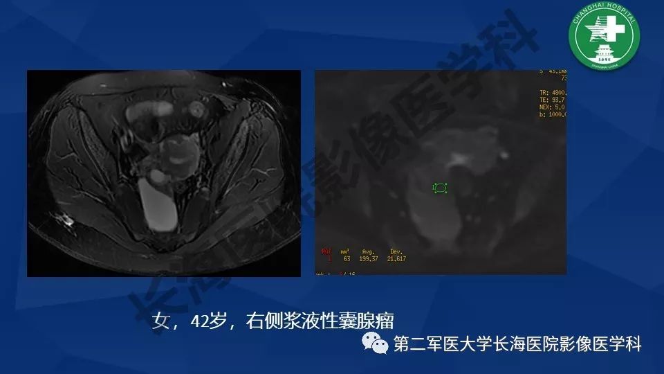 【PPT】卵巢上皮性肿瘤影像诊断