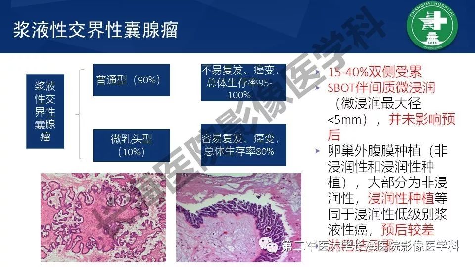 【PPT】卵巢上皮性肿瘤影像诊断