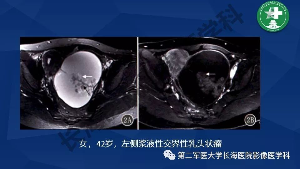 【PPT】卵巢上皮性肿瘤影像诊断