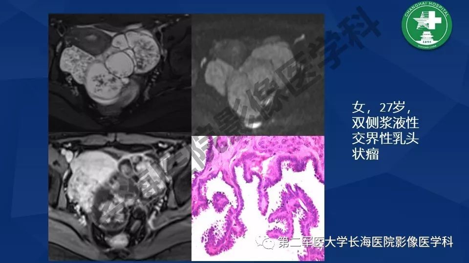 【PPT】卵巢上皮性肿瘤影像诊断