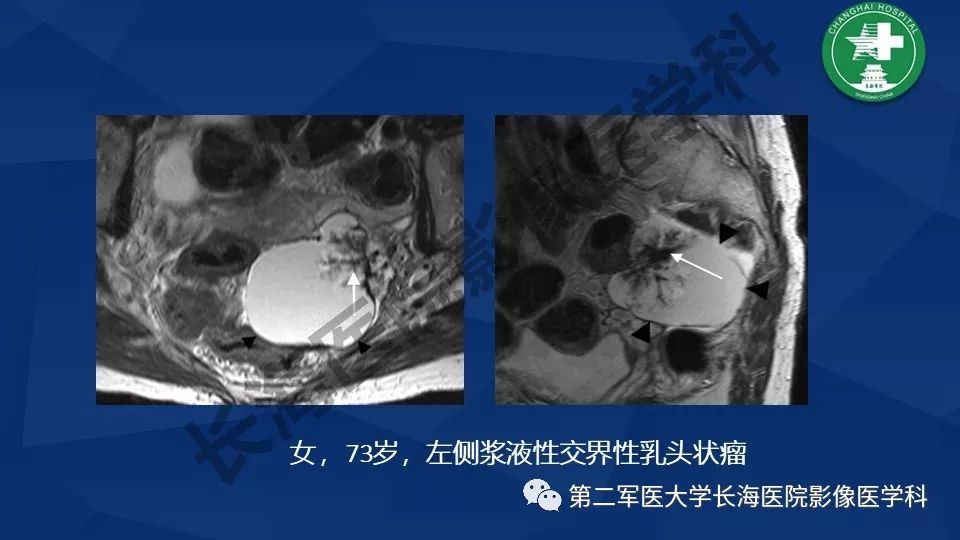 【PPT】卵巢上皮性肿瘤影像诊断