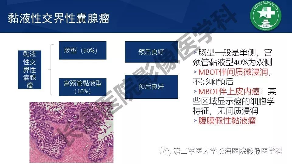 【PPT】卵巢上皮性肿瘤影像诊断