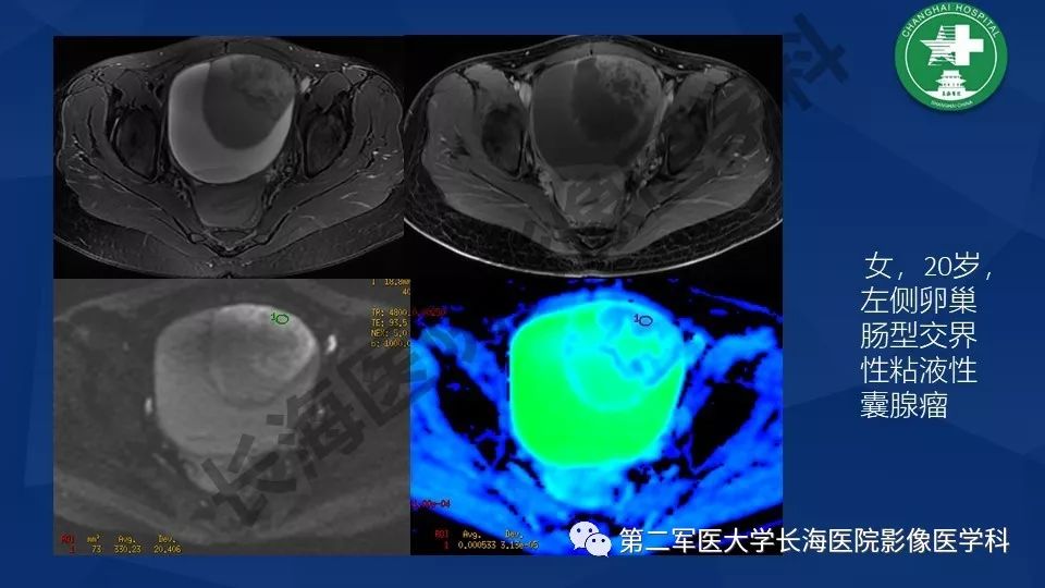 【PPT】卵巢上皮性肿瘤影像诊断
