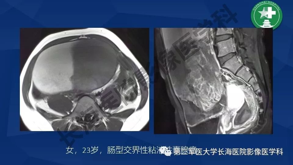 【PPT】卵巢上皮性肿瘤影像诊断
