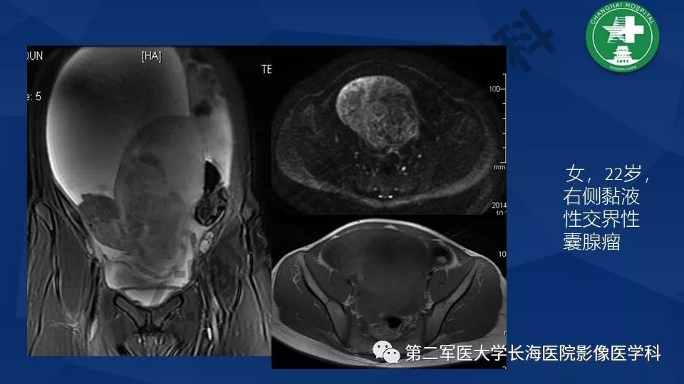 【PPT】卵巢上皮性肿瘤影像诊断