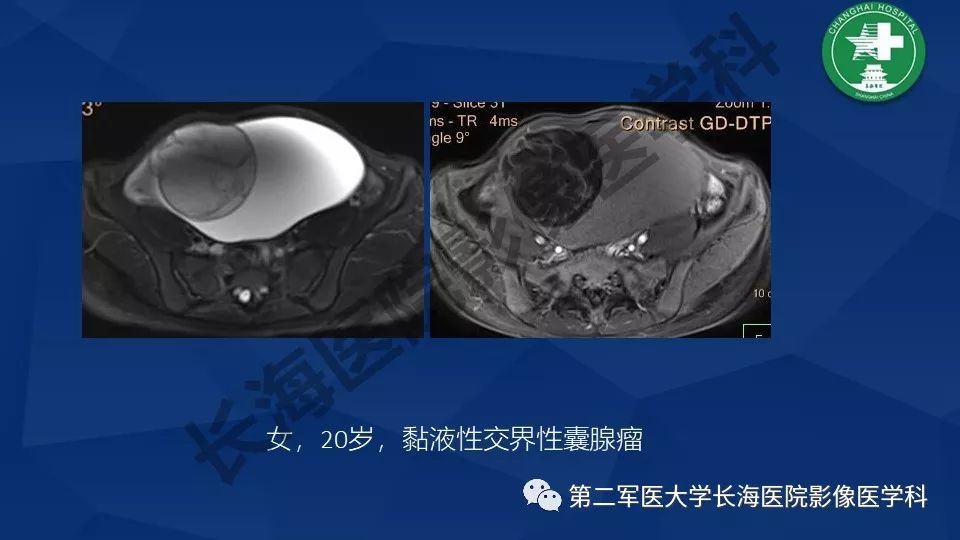 【PPT】卵巢上皮性肿瘤影像诊断
