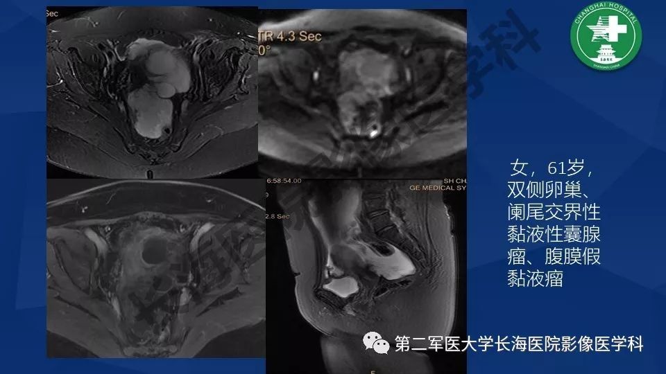 【PPT】卵巢上皮性肿瘤影像诊断