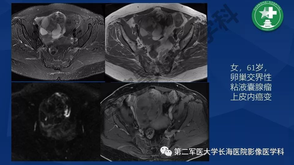 【PPT】卵巢上皮性肿瘤影像诊断