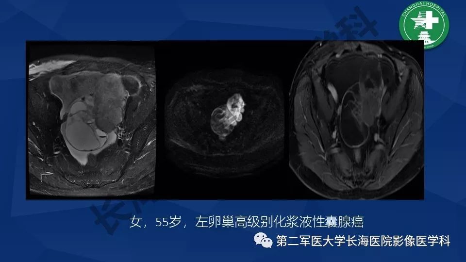 【PPT】卵巢上皮性肿瘤影像诊断