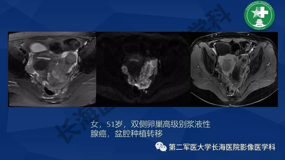 【PPT】卵巢上皮性肿瘤影像诊断