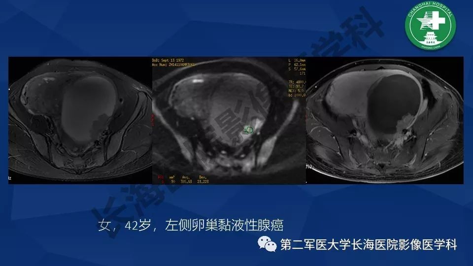 【PPT】卵巢上皮性肿瘤影像诊断