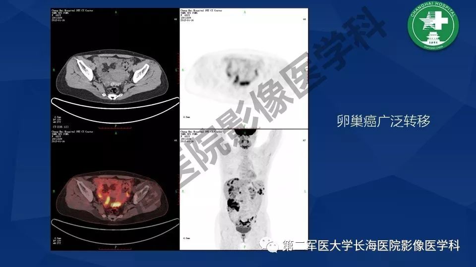 【PPT】卵巢上皮性肿瘤影像诊断