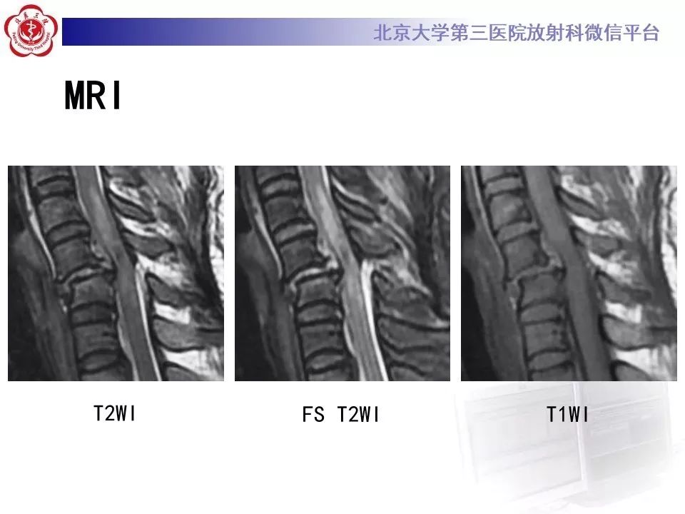 【病例】创伤性椎间盘突出1例MR