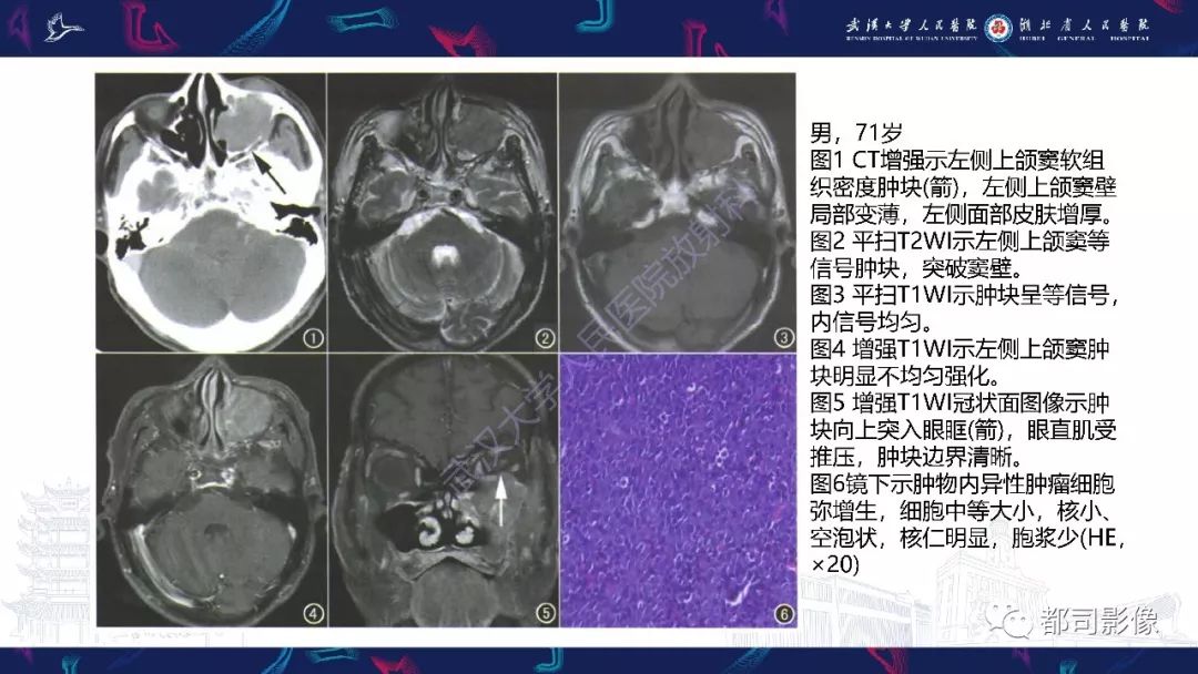 【PPT】上颌窦非霍奇金淋巴瘤影像诊断