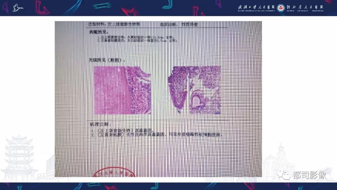 【PPT】上颌窦非霍奇金淋巴瘤影像诊断