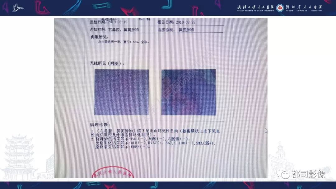 【PPT】上颌窦非霍奇金淋巴瘤影像诊断