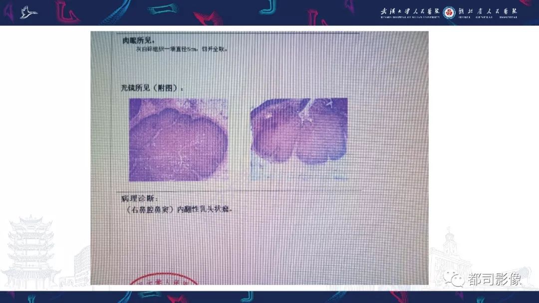 【PPT】上颌窦非霍奇金淋巴瘤影像诊断
