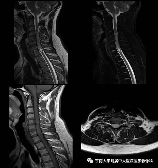 【病例】髓内室管膜瘤1例MR影像