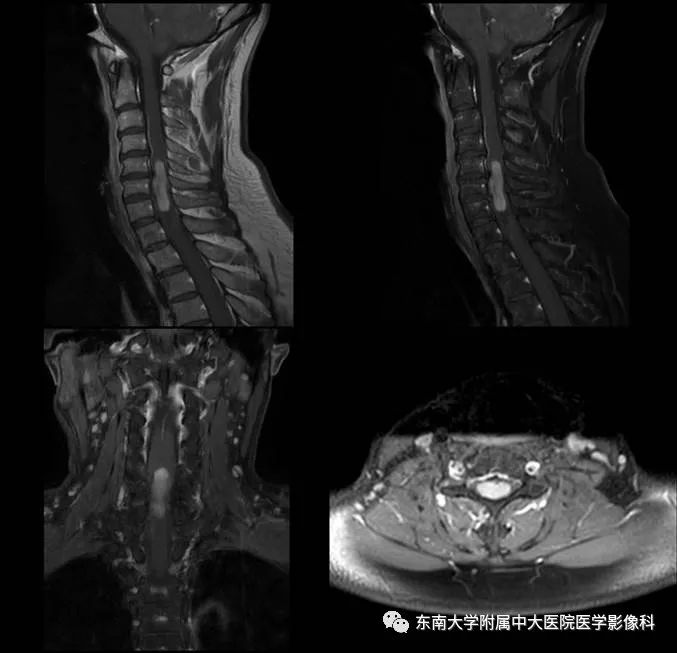 【病例】髓内室管膜瘤1例MR影像