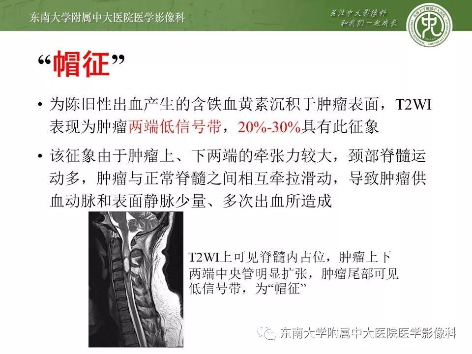 【病例】髓内室管膜瘤1例MR影像