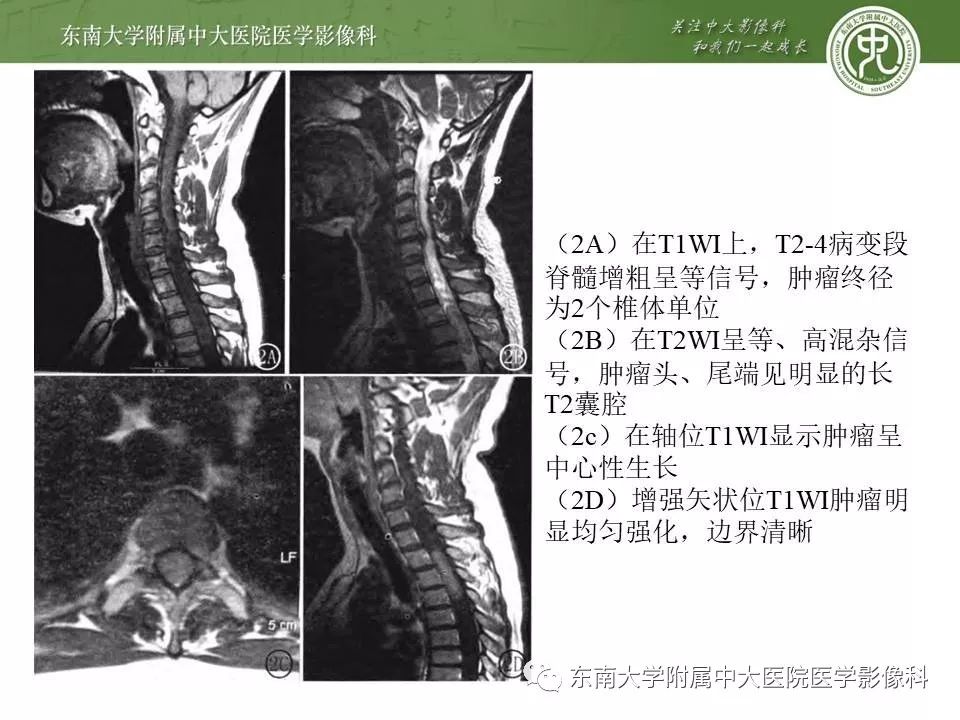 【病例】髓内室管膜瘤1例MR影像