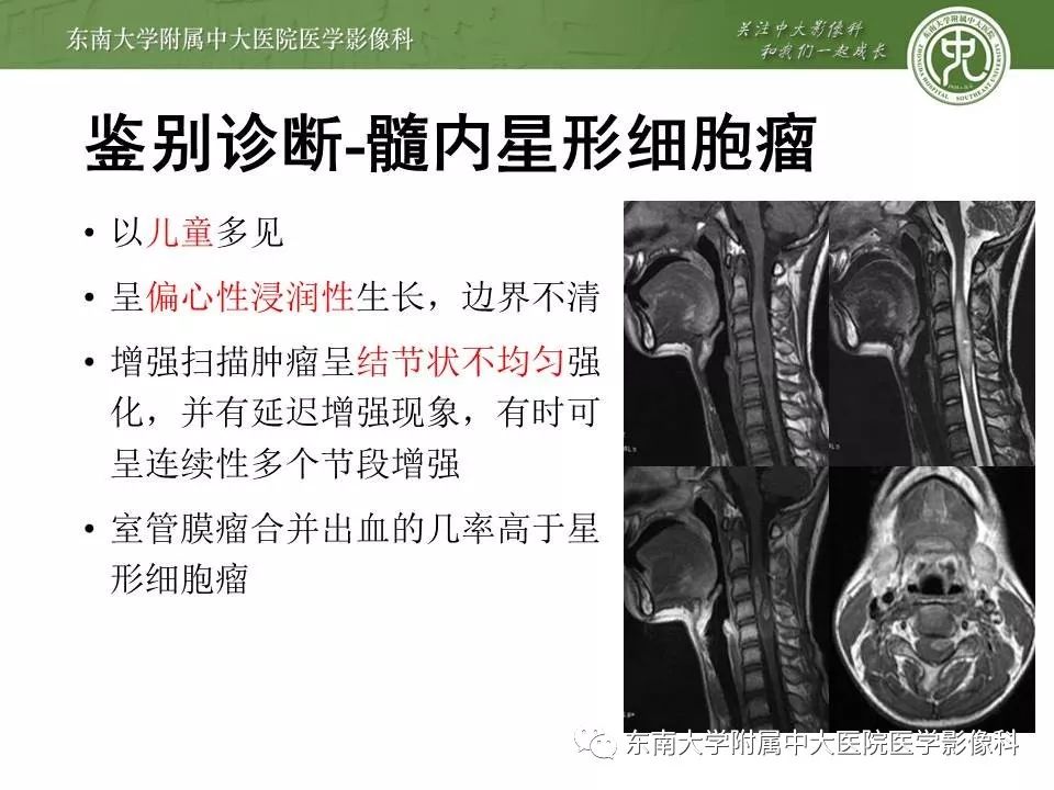 【病例】髓内室管膜瘤1例MR影像