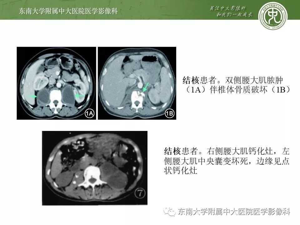 【病例】腰大肌脓肿1例CT影像