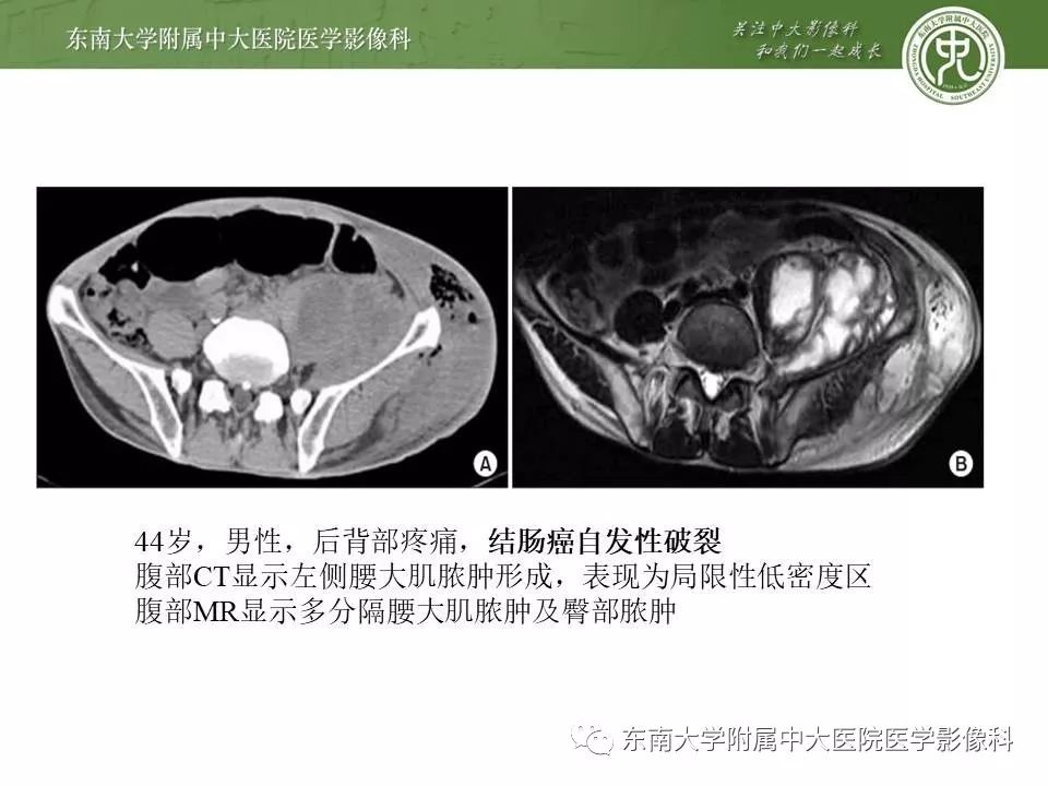 【病例】腰大肌脓肿1例CT影像