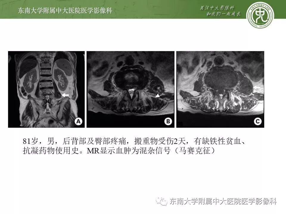 【病例】腰大肌脓肿1例CT影像