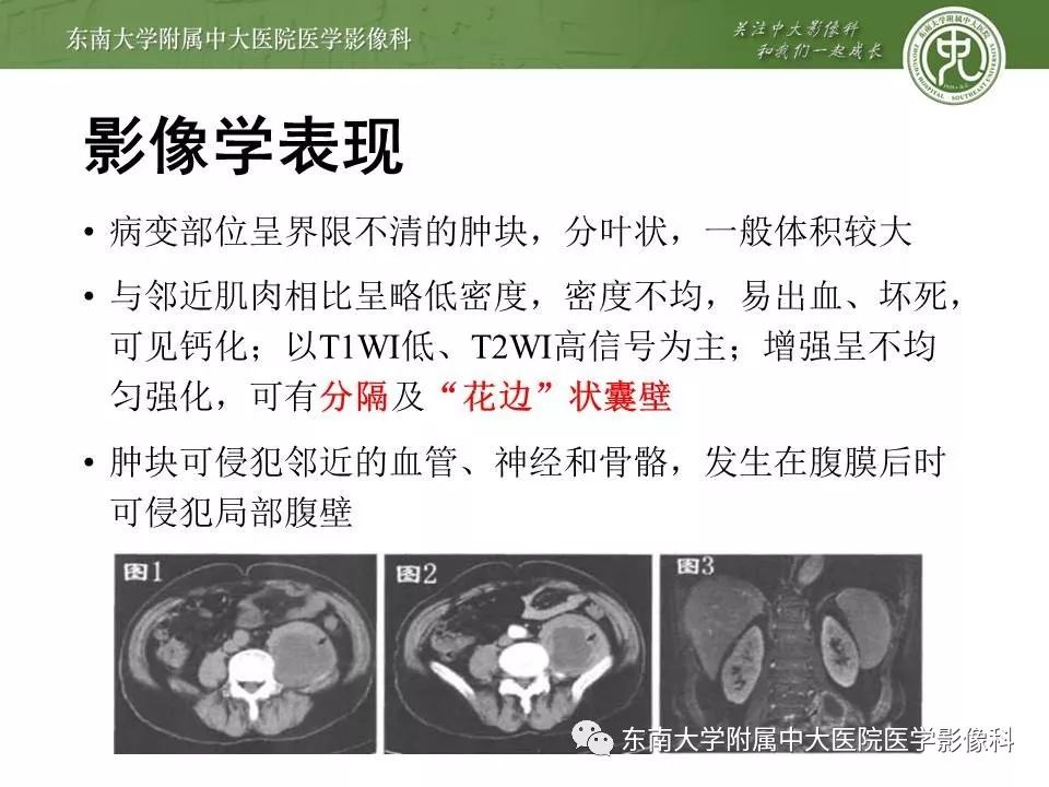 【病例】腰大肌脓肿1例CT影像