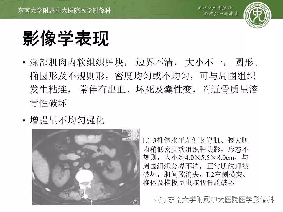 【病例】腰大肌脓肿1例CT影像