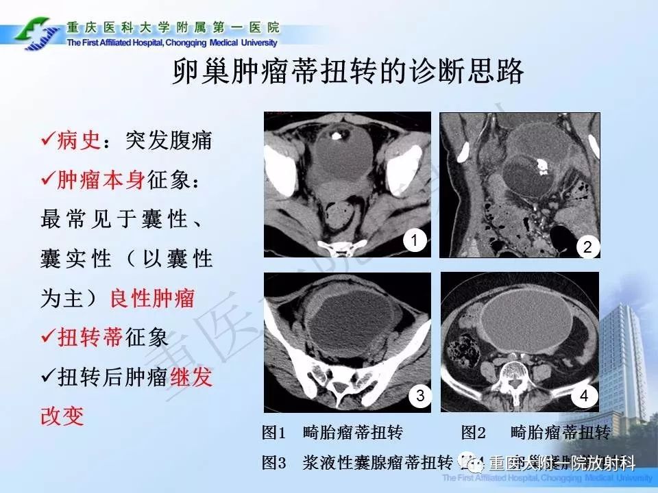 【PPT】卵巢肿瘤蒂扭转的CT诊断