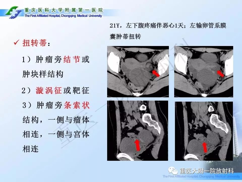 【PPT】卵巢肿瘤蒂扭转的CT诊断